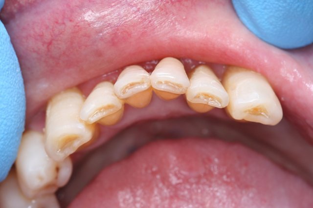 Incisal Bonding Before
